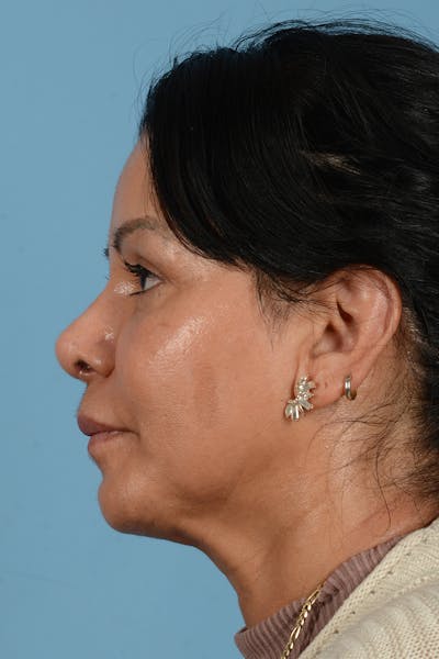 Eyelid Lift Before & After Gallery - Patient 831777 - Image 10