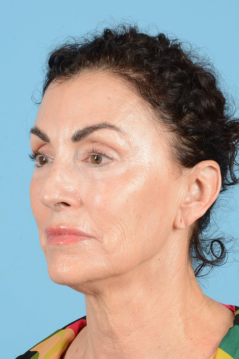 Facelift Before & After Gallery - Patient 318562 - Image 7