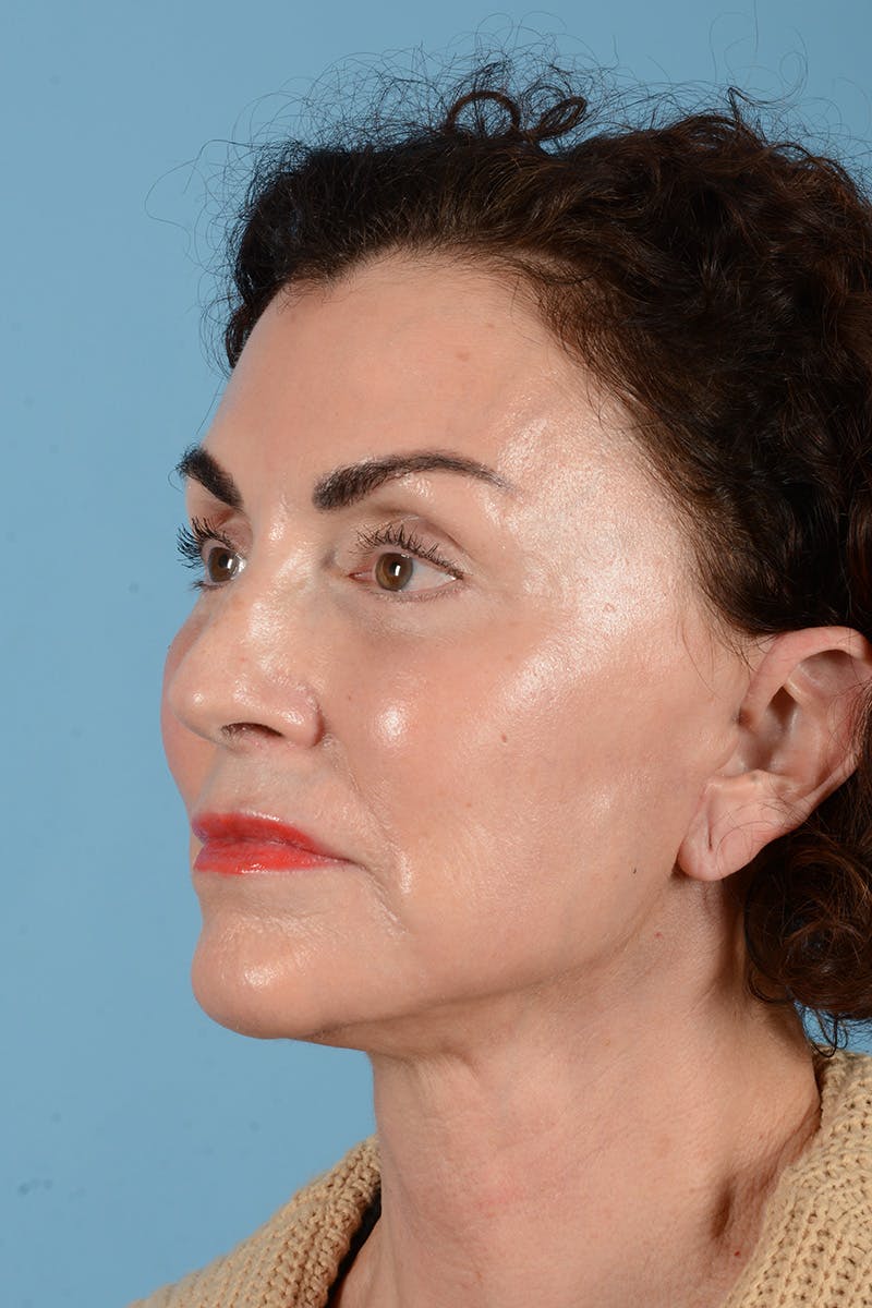 Facelift Before & After Gallery - Patient 318562 - Image 8