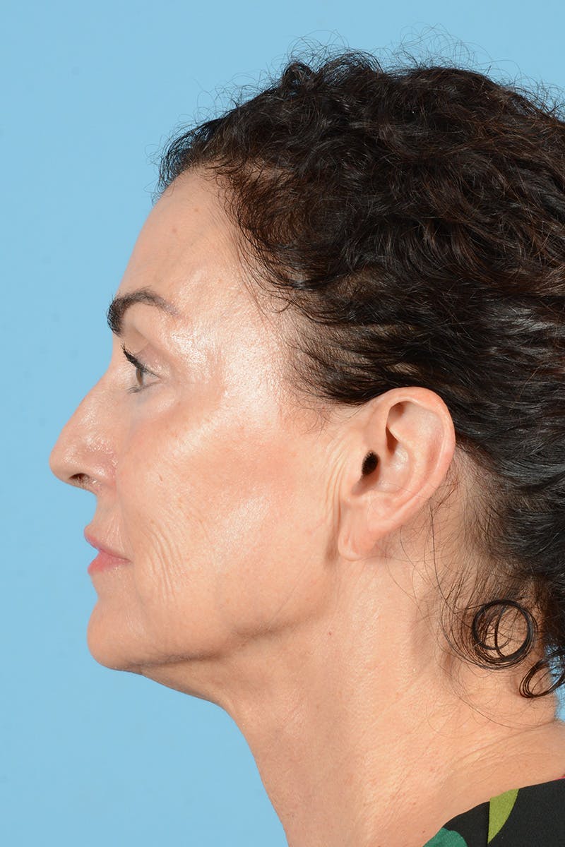 Facelift Before & After Gallery - Patient 318562 - Image 9