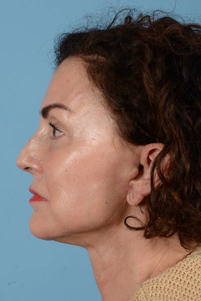 Facelift Before & After Gallery - Patient 318562 - Image 10
