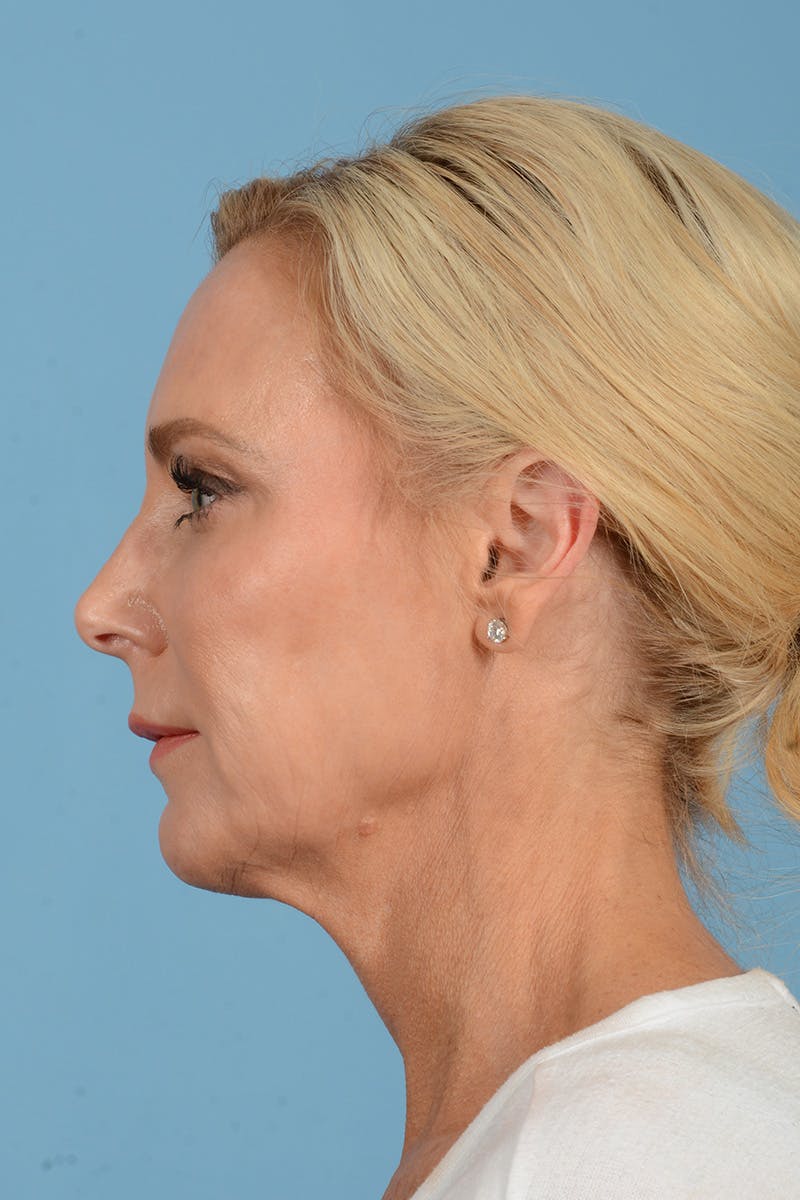 Neck Lift Before & After Gallery - Patient 357591 - Image 9