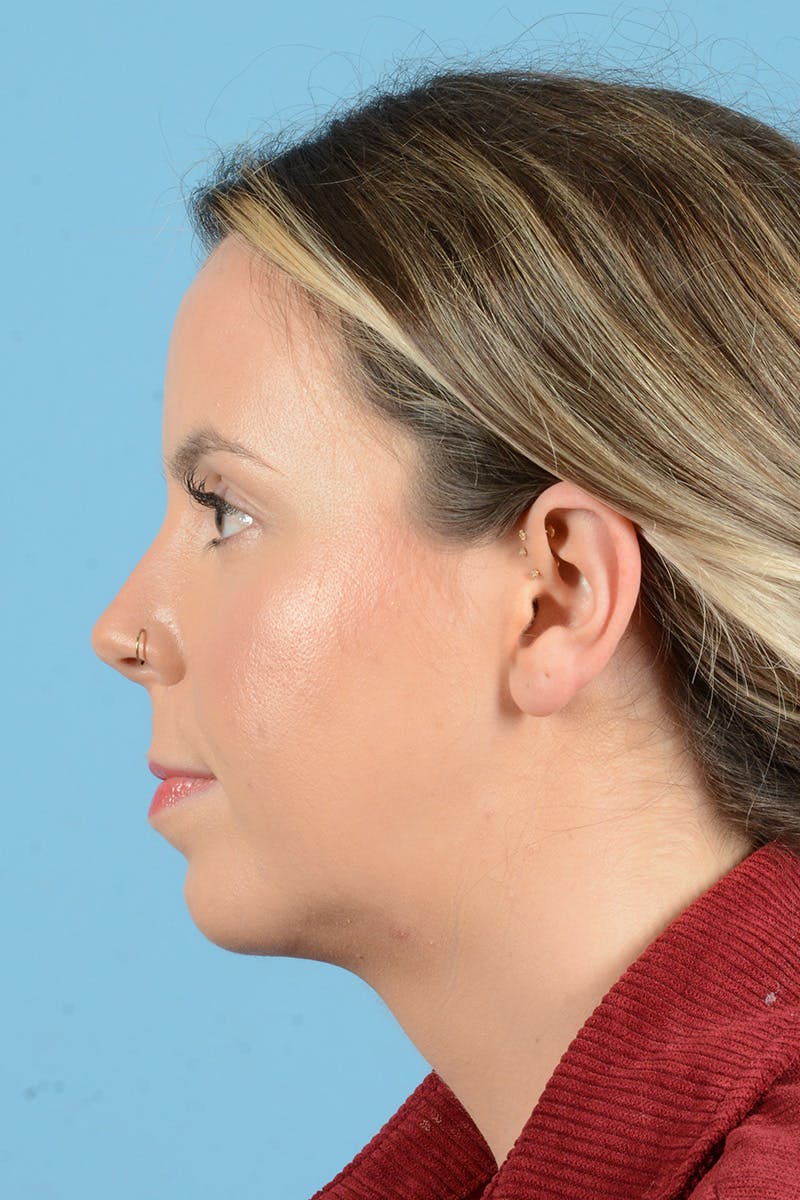 Facial Augmentation Before & After Gallery - Patient 316455 - Image 10