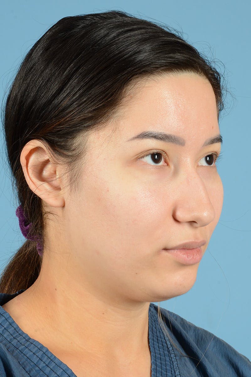 Facial Augmentation Before & After Gallery - Patient 230673 - Image 3