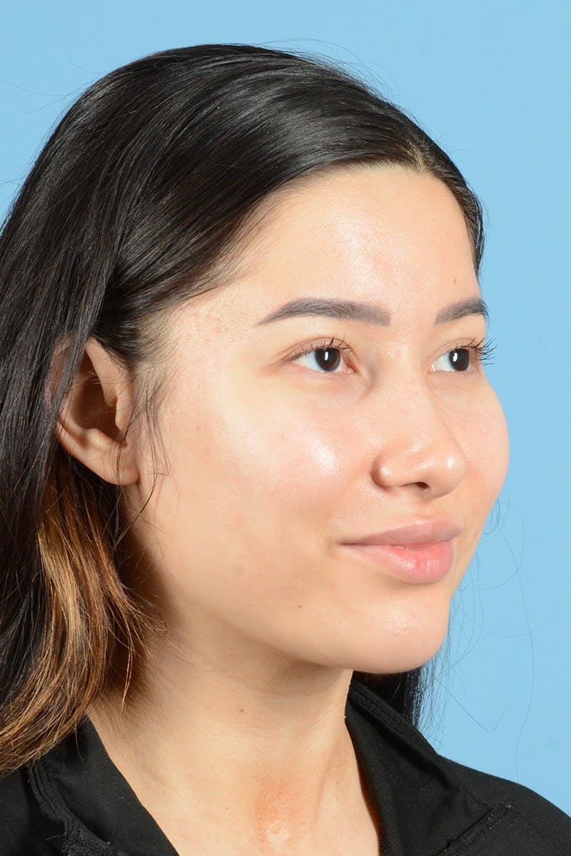 Facial Augmentation Before & After Gallery - Patient 230673 - Image 4