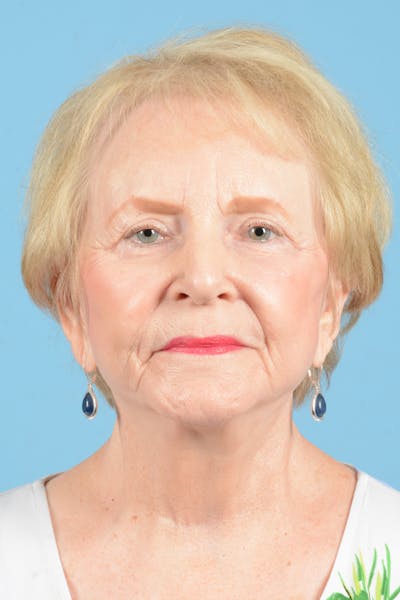 Eyelid Lift Before & After Gallery - Patient 327998 - Image 2