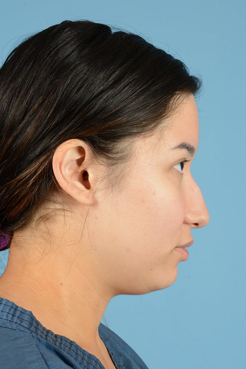 Facial Augmentation Before & After Gallery - Patient 230673 - Image 5