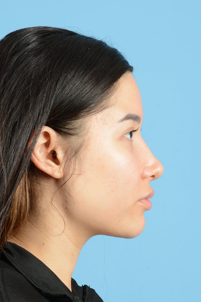 Facial Augmentation Before & After Gallery - Patient 230673 - Image 6