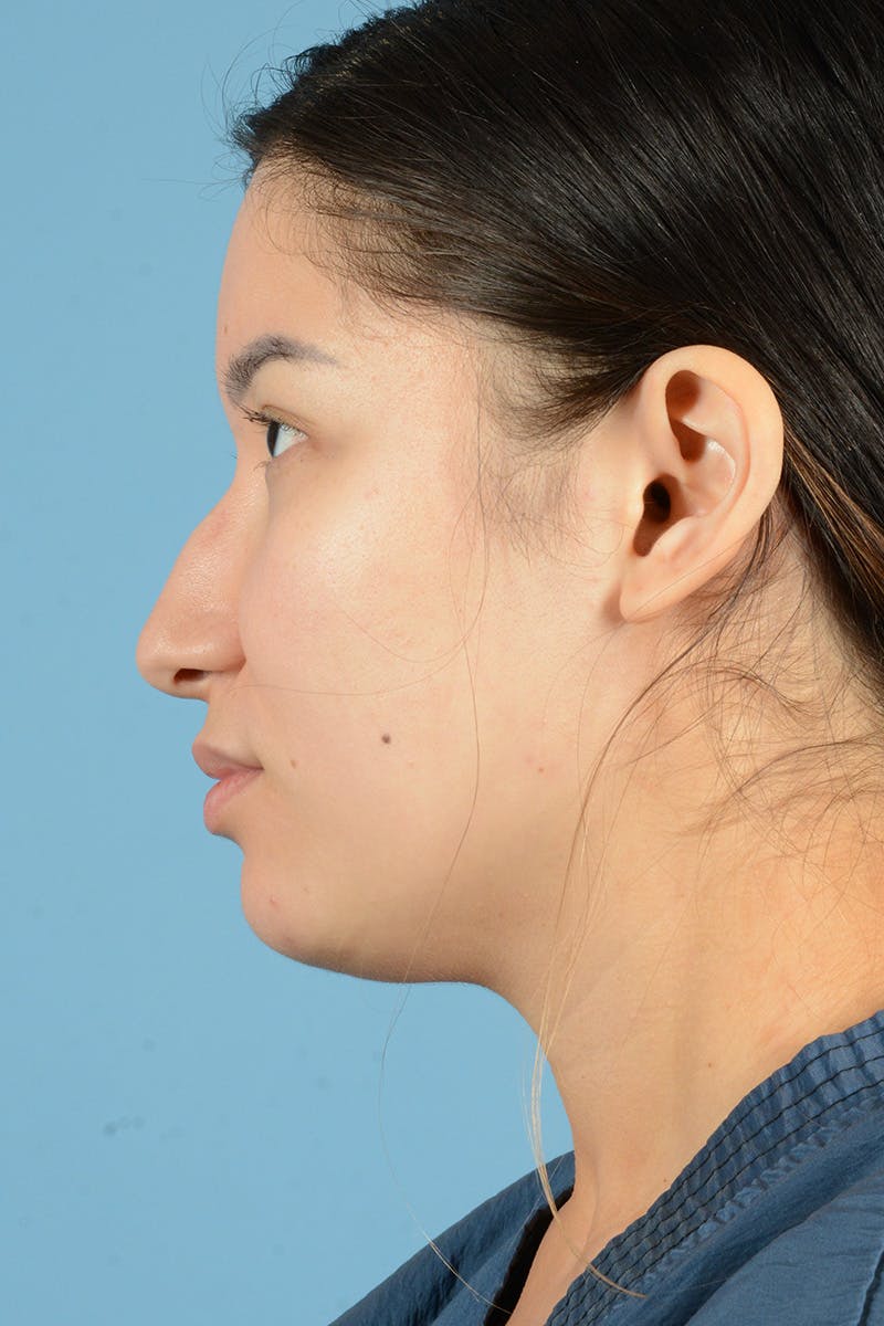 Facial Augmentation Before & After Gallery - Patient 230673 - Image 9