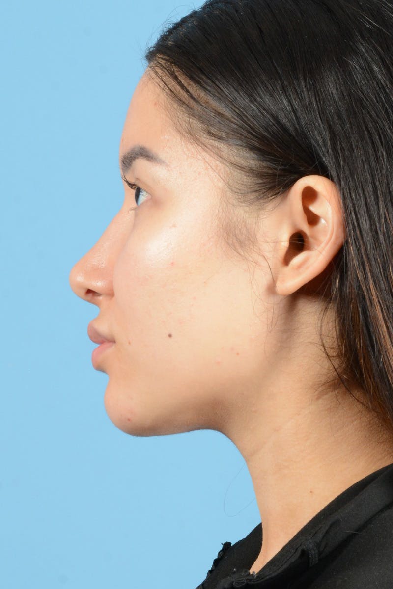 Facial Augmentation Before & After Gallery - Patient 230673 - Image 10