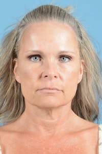 Facial Augmentation Before & After Gallery - Patient 118941 - Image 1