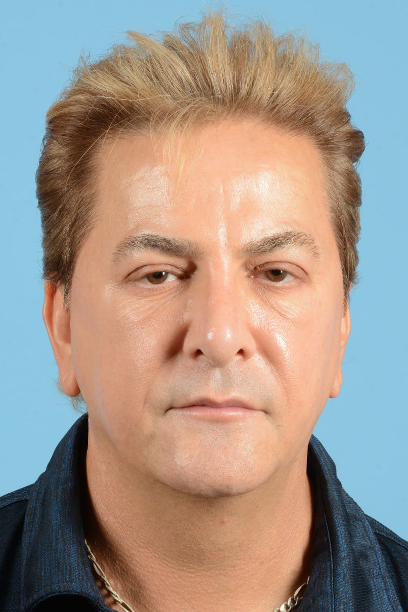 Rhinoplasty Before & After Gallery - Patient 110435 - Image 1