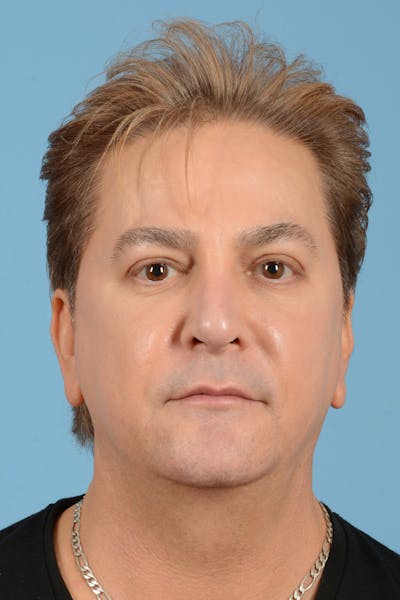Rhinoplasty Before & After Gallery - Patient 110435 - Image 2