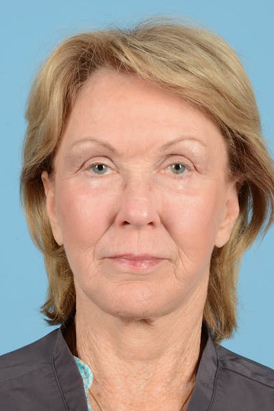 Eyelid Lift Before & After Gallery - Patient 192282 - Image 2