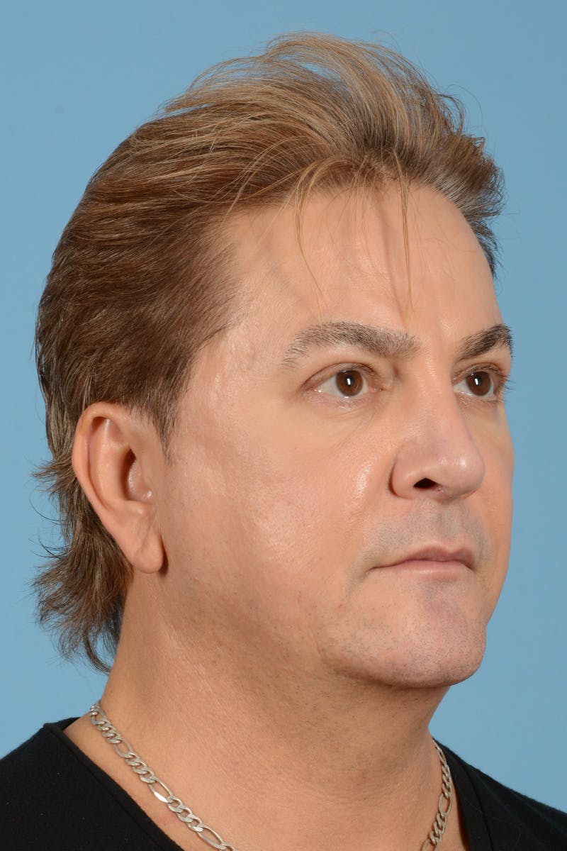 Rhinoplasty Before & After Gallery - Patient 110435 - Image 4