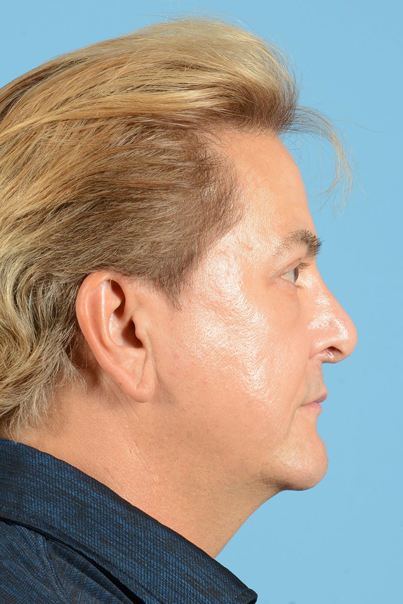 Rhinoplasty Before & After Gallery - Patient 110435 - Image 5