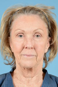 Facelift Before & After Gallery - Patient 857596 - Image 1