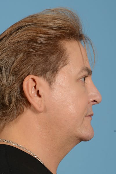 Rhinoplasty Before & After Gallery - Patient 110435 - Image 6
