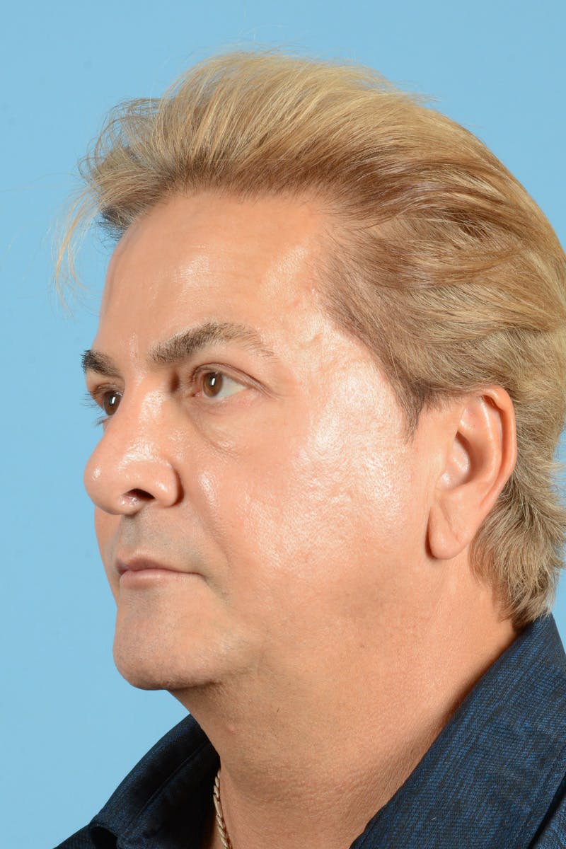 Rhinoplasty Before & After Gallery - Patient 110435 - Image 7