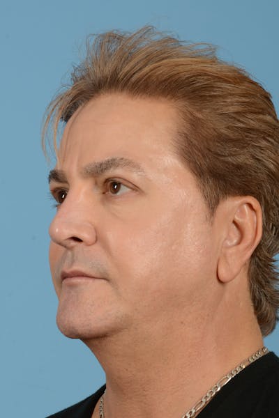 Rhinoplasty Before & After Gallery - Patient 110435 - Image 8