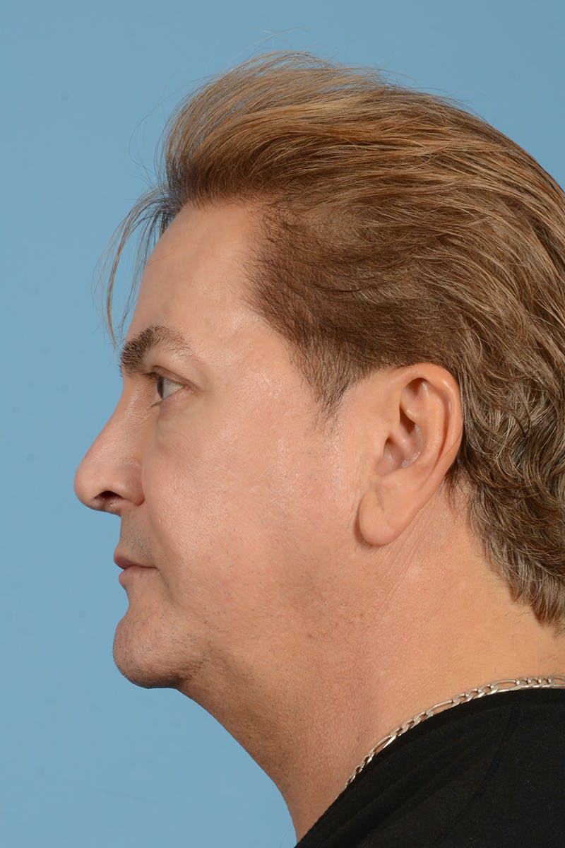 Rhinoplasty Before & After Gallery - Patient 110435 - Image 10