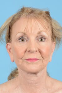 Eyelid Lift Before & After Gallery - Patient 188945 - Image 1