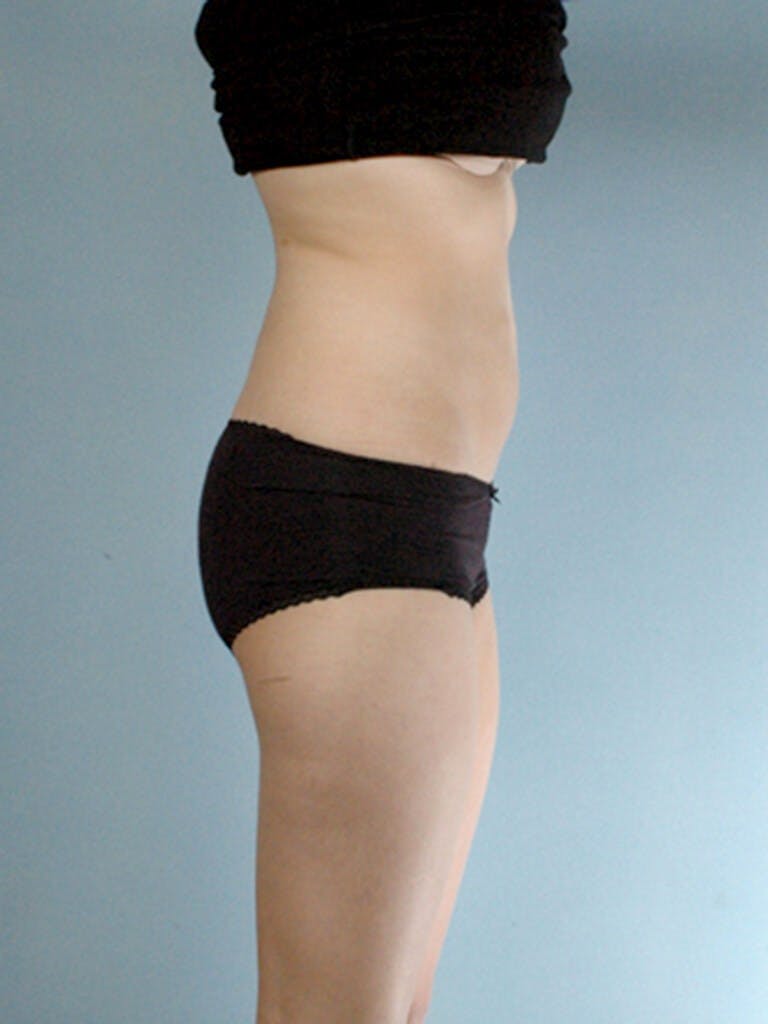 Brazilian Butt Lift Before & After Gallery - Patient 823548 - Image 1