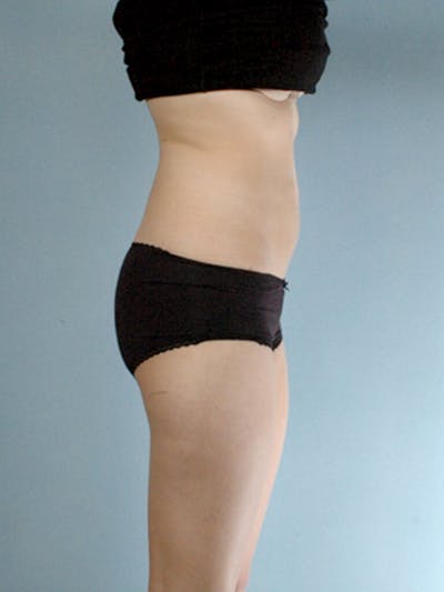 Brazilian Butt Lift Before & After Gallery - Patient 823548 - Image 1