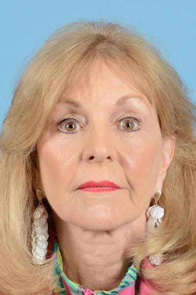 Eyelid Lift Before & After Gallery - Patient 188945 - Image 2