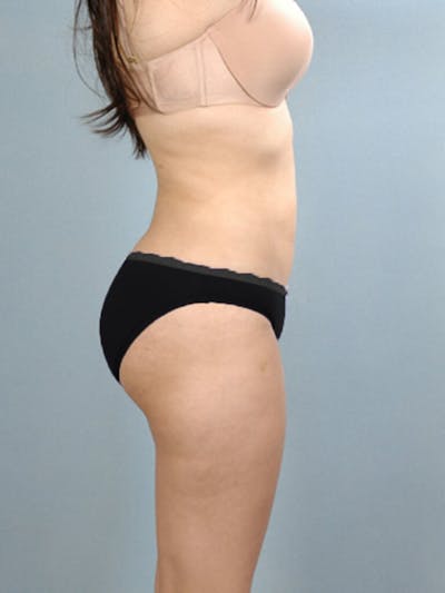 Brazilian Butt Lift Before & After Gallery - Patient 823548 - Image 2