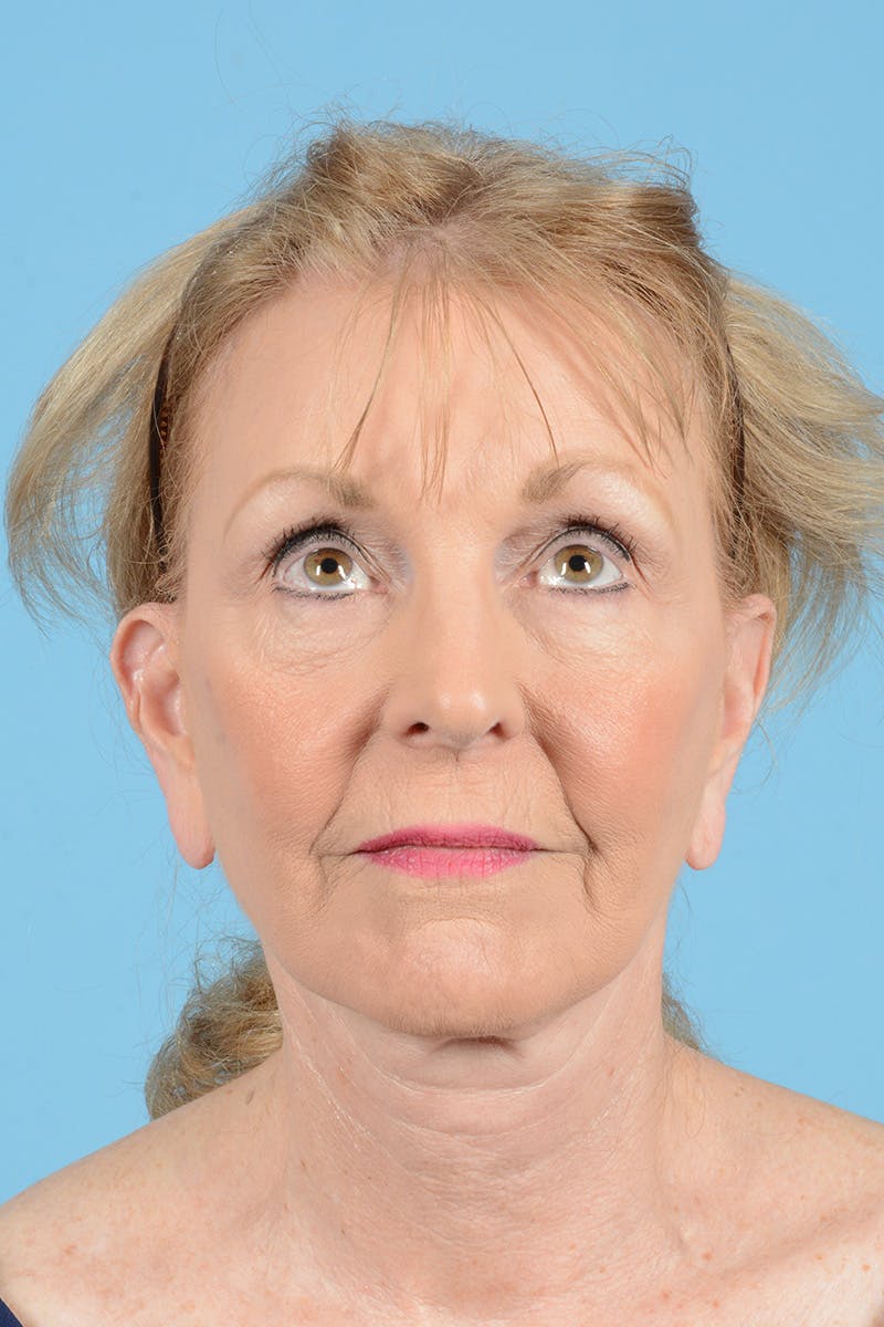 Eyelid Lift Before & After Gallery - Patient 188945 - Image 3
