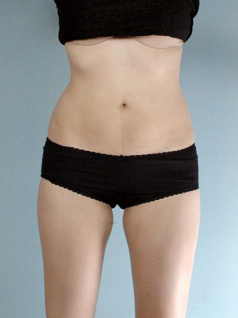 Brazilian Butt Lift Before & After Gallery - Patient 823548 - Image 3