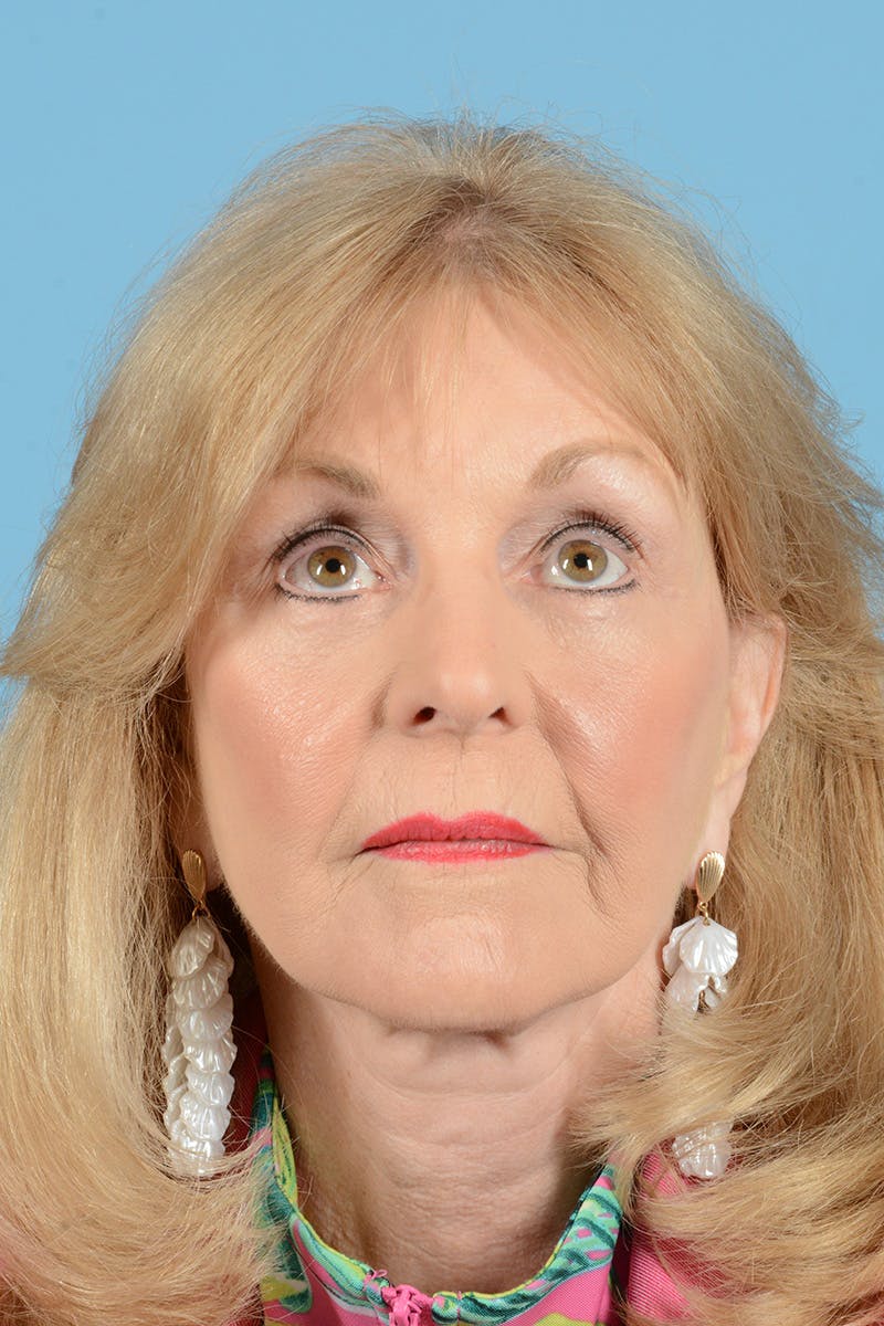 Eyelid Lift Before & After Gallery - Patient 188945 - Image 4