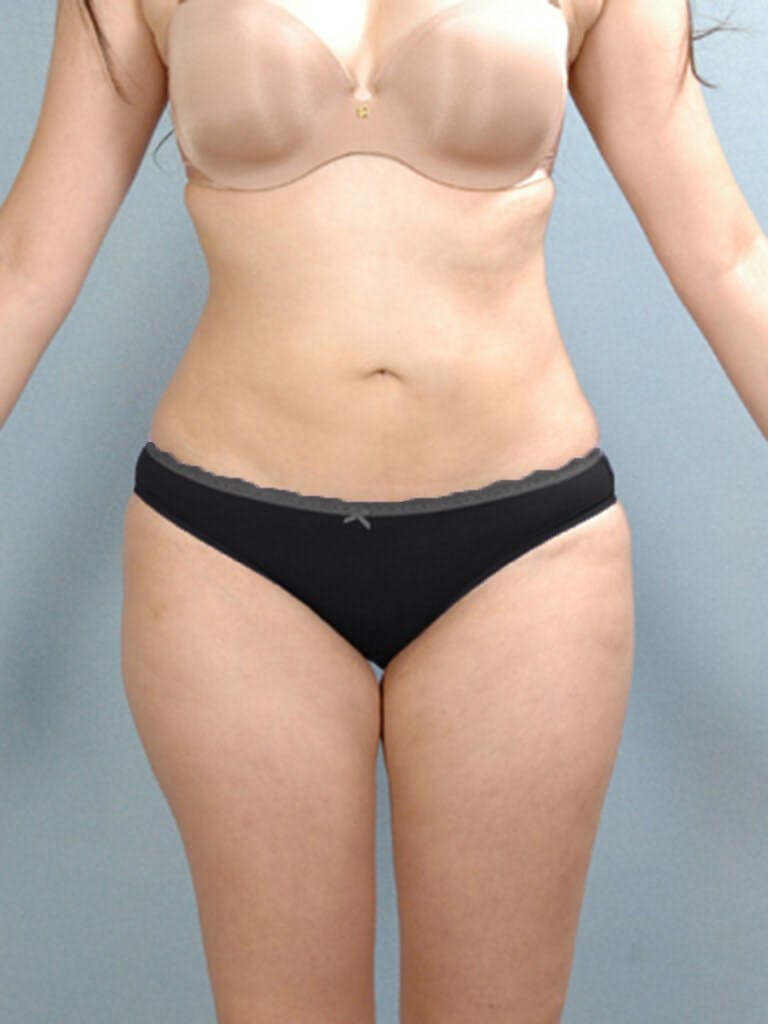 Brazilian Butt Lift Before & After Gallery - Patient 823548 - Image 4