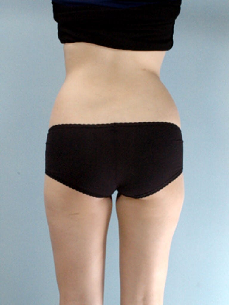 Brazilian Butt Lift Before & After Gallery - Patient 823548 - Image 5