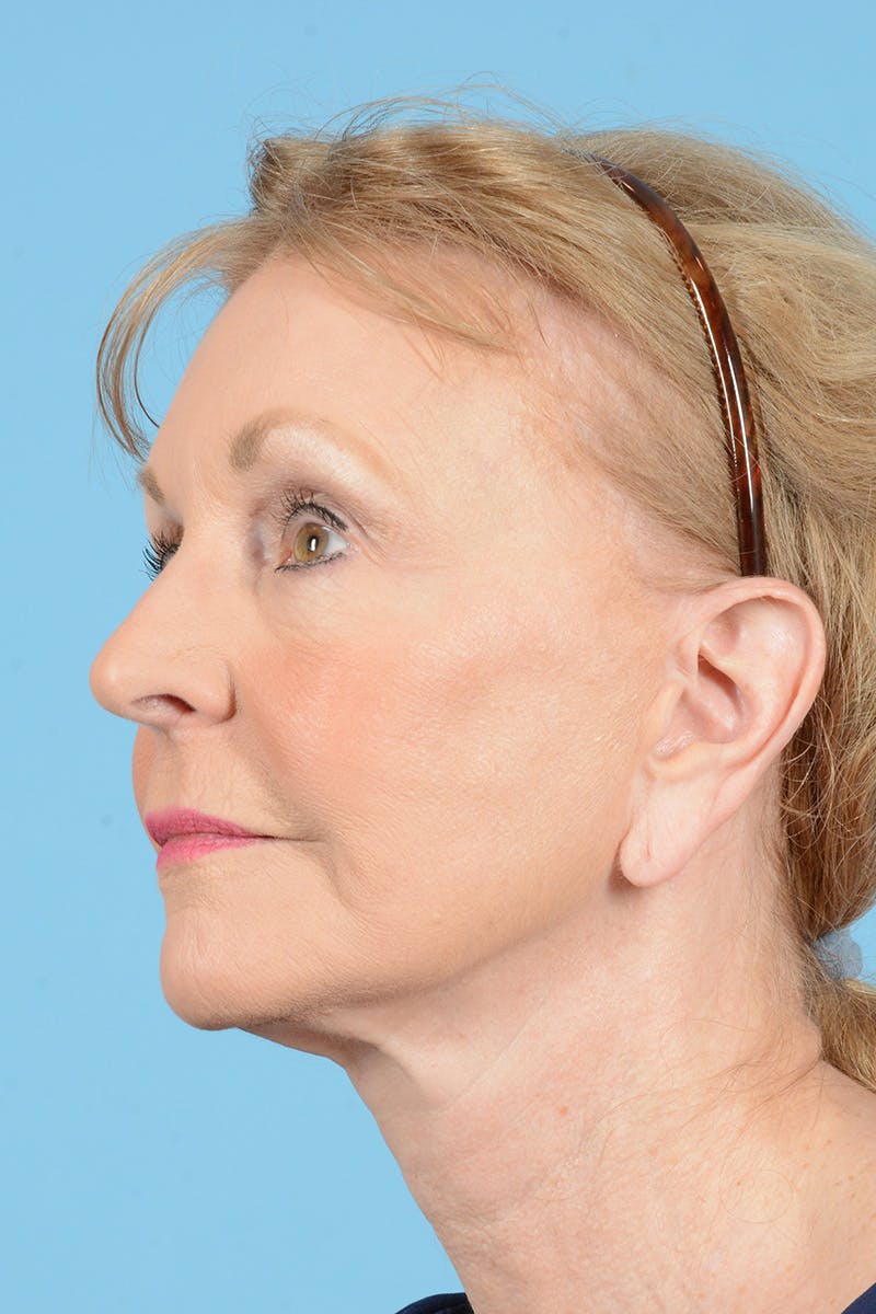 Eyelid Lift Before & After Gallery - Patient 188945 - Image 5