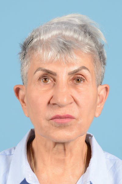 Facelift Before & After Gallery - Patient 336103 - Image 1