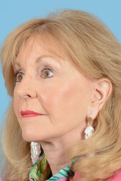 Eyelid Lift Before & After Gallery - Patient 188945 - Image 6
