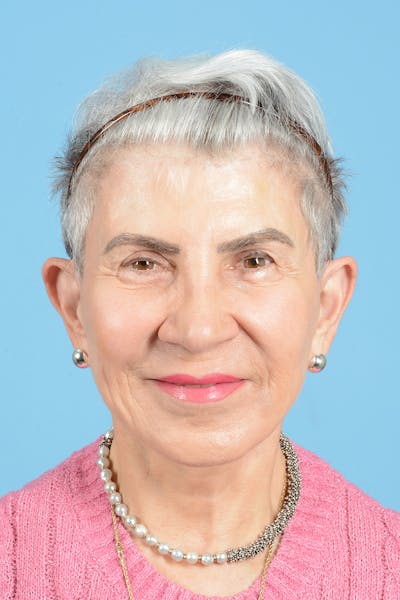 Facelift Before & After Gallery - Patient 336103 - Image 2