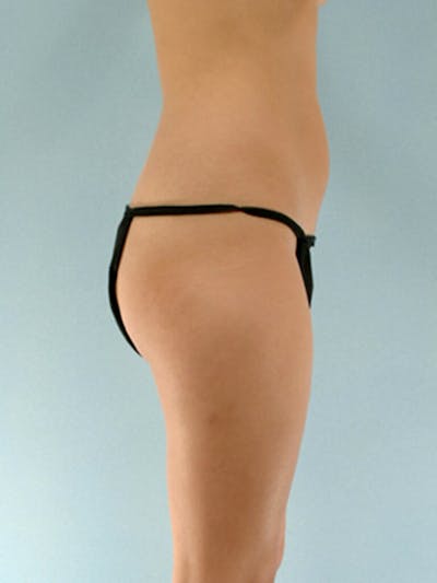 Brazilian Butt Lift Before & After Gallery - Patient 268116 - Image 1