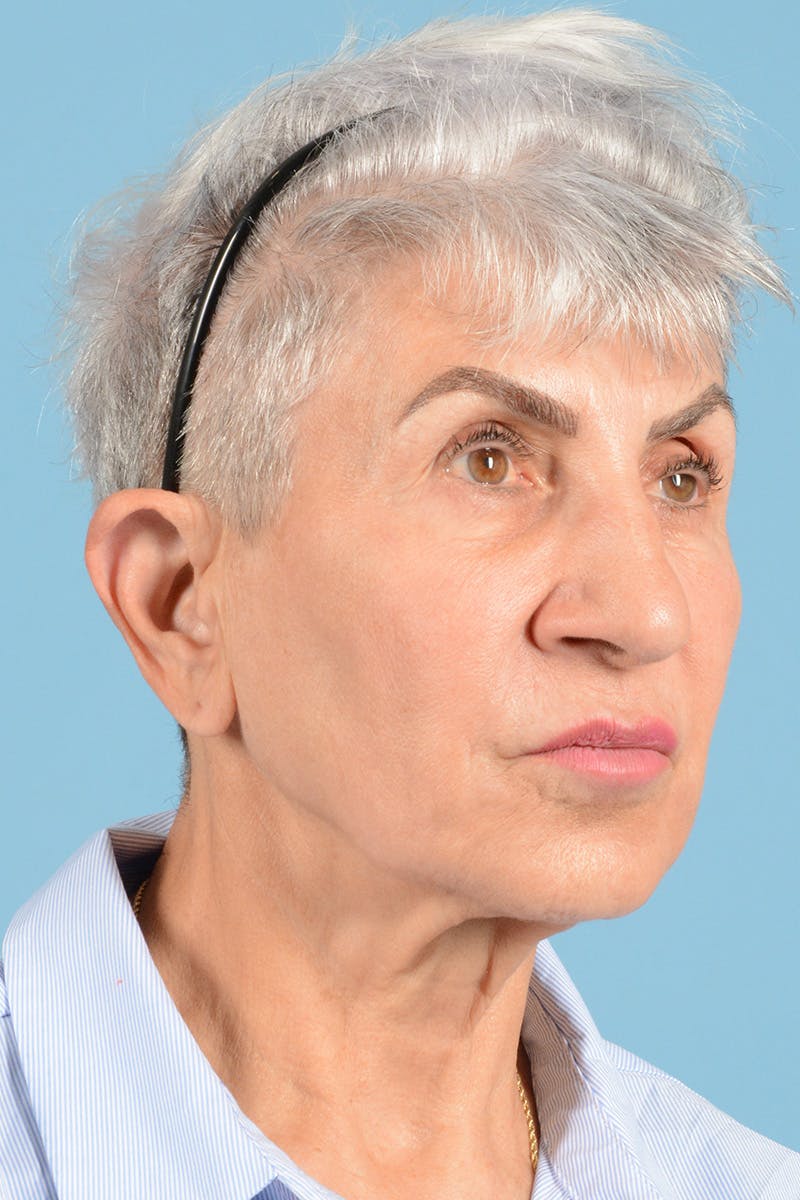 Facelift Before & After Gallery - Patient 336103 - Image 3