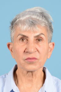 Eyelid Lift Before & After Gallery - Patient 365054 - Image 1