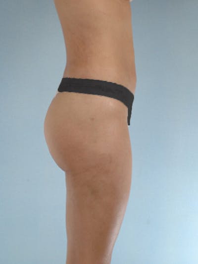Brazilian Butt Lift Before & After Gallery - Patient 268116 - Image 2