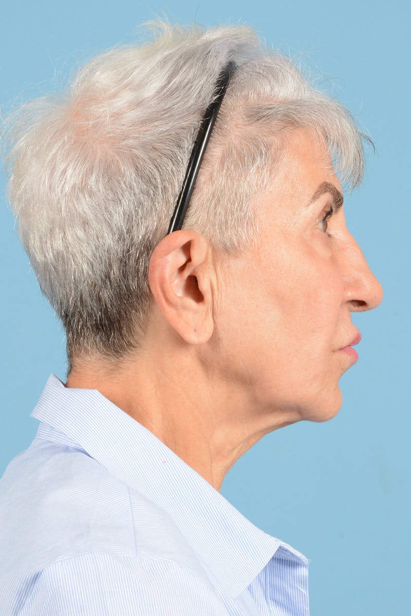 Facelift Before & After Gallery - Patient 336103 - Image 5