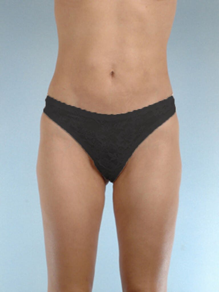 Brazilian Butt Lift Before & After Gallery - Patient 268116 - Image 4
