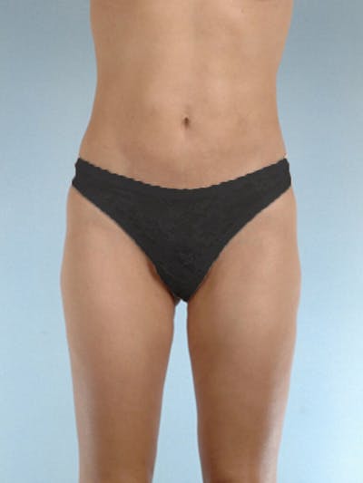 Brazilian Butt Lift Before & After Gallery - Patient 268116 - Image 4