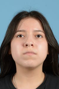 Facial Augmentation Before & After Gallery - Patient 217075 - Image 1