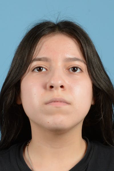 Facial Augmentation Before & After Gallery - Patient 217075 - Image 1