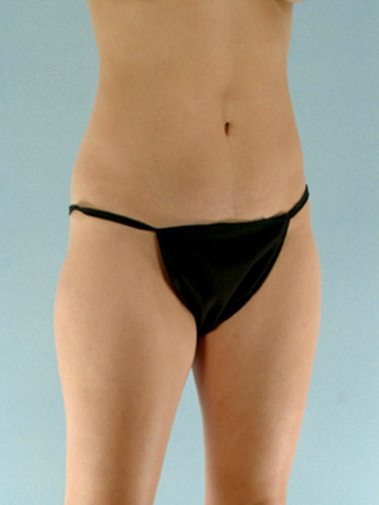 Brazilian Butt Lift Before & After Gallery - Patient 268116 - Image 5