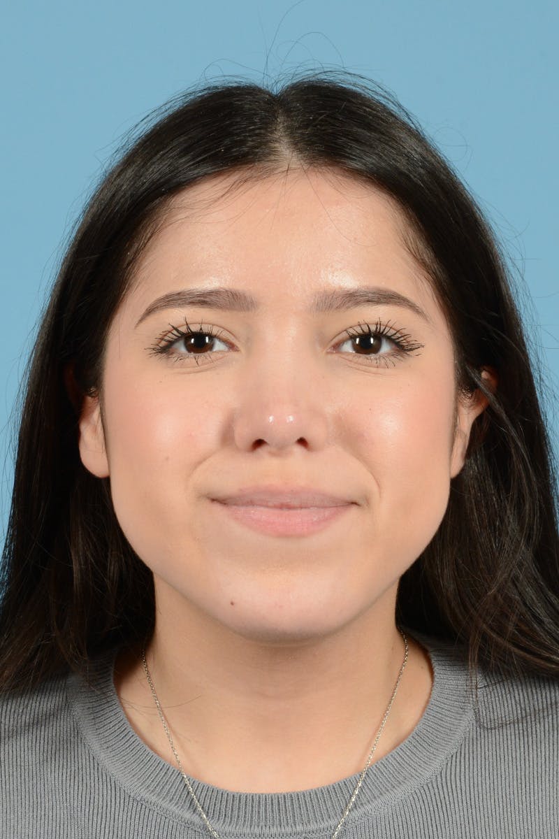 Facial Augmentation Before & After Gallery - Patient 217075 - Image 2